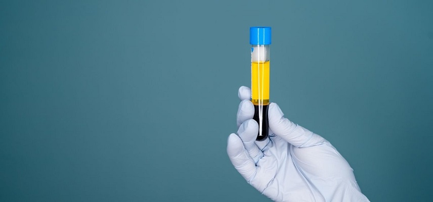 Roche’s Blood Test, Elecsys pTau217 Assay Gets BDD